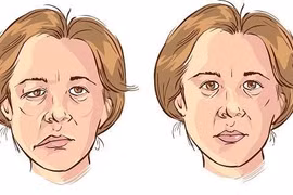 Cách cải thiện tai biến mạch máu não ở người già nhờ sản phẩm từ thiên nhiên