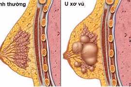 15 tuổi đã phải mổ u xơ tuyến vú