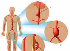 Bóc tách động mạch chủ có thể gây nhồi máu cơ tim