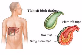 Đau lưng sau khi cắt túi mật