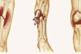 Không chủ quan với đau xương tuổi dậy thì