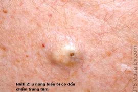  Cách nhận biết và xử lý các u phần mềm hay gặp