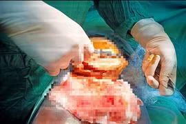 Các bác sĩ nối thành công dương vật cho phạm nhân
