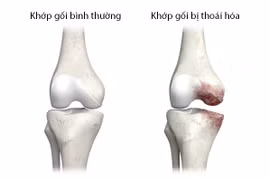 Làm gì để cải thiện thoái hóa khớp?