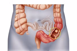 Người ung thư trực tràng nên ăn gì để tốt cho cơ thể?