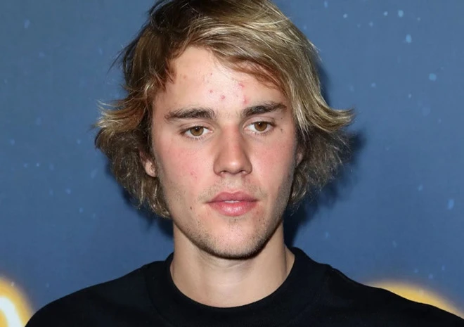 Giữa ồn ào với Taylor SwiftJustin, Bieber xuất hiện mặt đầy mụn