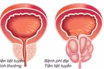 Tuyến tiền liệt phì đại, hiểu đúng để phòng ngừa, điều trị kịp thời