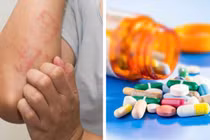 Dị ứng kháng sinh, tai biến y khoa ai cũng có thể gặp