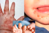 Cách phòng ngừa bệnh chân tay miệng