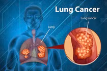 Ung thư phổi, ung thư đại trực tràng ngày càng trẻ hoá