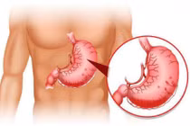 Bảo vệ dạ dày từ những thói quen nhỏ tránh xuất huyết tiêu hóa