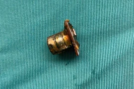 Bé 2 tuổi ở Phú Thọ thoát nguy kịch sau khi nuốt pin cúc áo