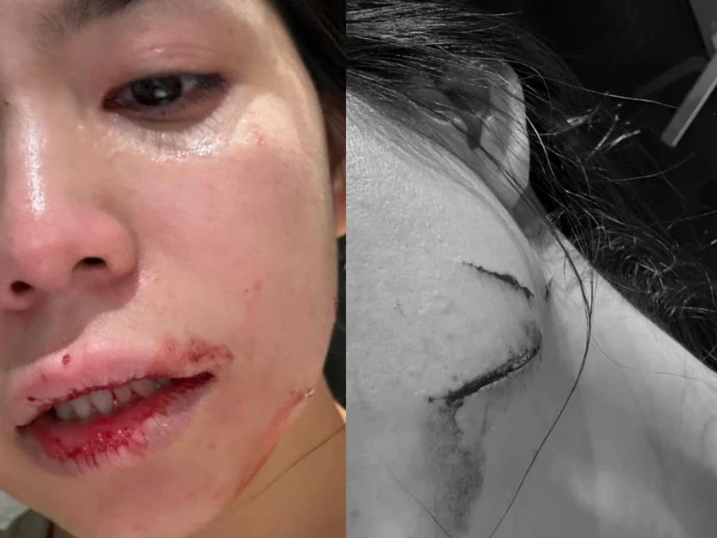 Hằng Du Mục tung hình ảnh đầy vết thương khi bị chồng bạo hành