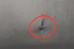 Bé 9 tuổi bị sỏi thận kích thước lớn gây thận ứ nước