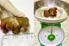 Sỏi san hô “khổng lồ” xâm lấn hết thận sau 20 năm tồn tại 