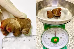 Sỏi san hô “khổng lồ” xâm lấn hết thận sau 20 năm tồn tại 