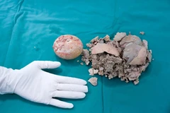 Sống chung sỏi bàng quang 30 năm, cô gái đau đớn vì sỏi 10cm