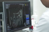 Từng bị đột quỵ nhưng tái phát vẫn nhập viện muộn, có bị coi nhẹ?