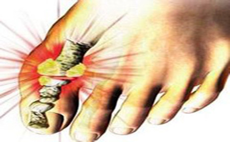 Do thân nhiệt giảm: Khi ngủ, hoạt động trao đổi chất trong cơ thể chậm lại khiến thân nhiệt giảm. Điều này cũng sẽ làm giảm độ bão hòa của axit uric trong máu nên thường gây ra những cơn đau nhức xương khớp vì thế, cần giữ ấm nhiệt ở tứ chi. Đặc biệt vào mùa hè nắng nóng bệnh nhân gout cần phải tránh ăn đồ lạnh. Ảnh: Sina.