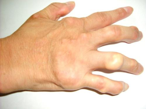 Để tránh ảnh hưởng đến chất lượng của giấc ngủ đêm, bệnh nhân gout ban ngày nên uống nhiều nước. Ngoài ra chú ý đến độ ẩm của phòng ngủ, nên đặt một cốc nước ở đầu giường để đêm có thể uống khi thấy khát. Ảnh: news.