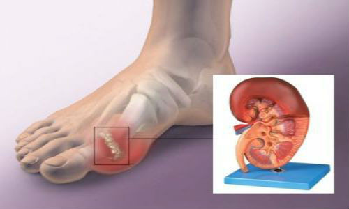 Biểu hiện lâm sàng đặc trưng bệnh gout thường là sưng tấy, nóng, đỏ, đau dữ dội tại một hay nhiều khớp. Nhưng vì sao bệnh nhân gout thường có những cơn đau về đêm? Ảnh: sj88.