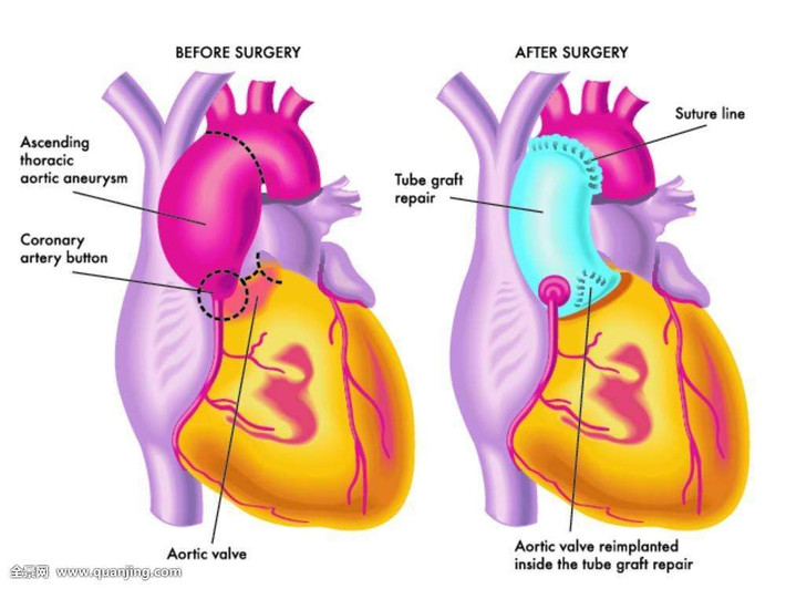 Theo các chuyên gia của hiệp hội Tim mạch Mỹ, việc ăn quá nhiều thực phẩm nhiều cholesterol, chất béo bão hòa và chất béo chuyển vị có thể khiến mỡ máu cao, đe dọa sức khỏe tim mạch của bạn. Ảnh: quanjing.