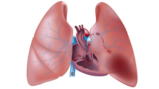 Tắc mạch phổi có biểu hiện đặc trưng là đau ngực, thở ngắn, ngất xỉu và lo lắng. Một nghiên cứu năm 2013 cho thấy có tới 33,5% bệnh nhân bệnh này bị chẩn đoán sai. Bác sĩ thường nhầm bệnh này với bệnh viêm phổi hoặc đau tim.