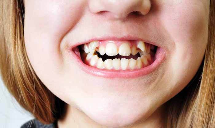 Răng khấp khiểng: Trong nhân tướng học thì những người phụ nữ có hàm răng khấp khểnh thường là người nguy hiểm thích buôn chuyện, đưa chuyện nên tính trung thực đáng tin cậy của họ thường rất thấp.