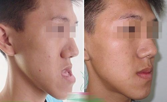 Trần Lữ Anh Khoa sinh năm 1997, học sinh trường THPT Cái Bè, huyện Cai Lậy, Tiền Giang, luôn tự ti vì chứng phì đại xương hàm khiến gương mặt xấu xí. Cậu quyết định chi 80 triệu đồng để phẫu thuật thẩm mỹ.