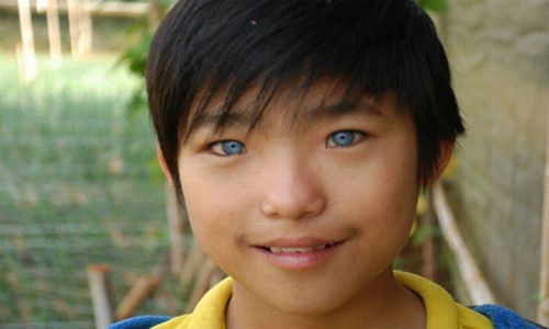 Cậu bé Nguyễn Văn Hào ở Đà Lạt sinh năm 1999 cũng sở hữu đôi mắt màu xanh nước biển khiến nhiều người ngỡ ngàng. Đôi mắt lạ khiến bé Hào gặp không ít phiền toái.