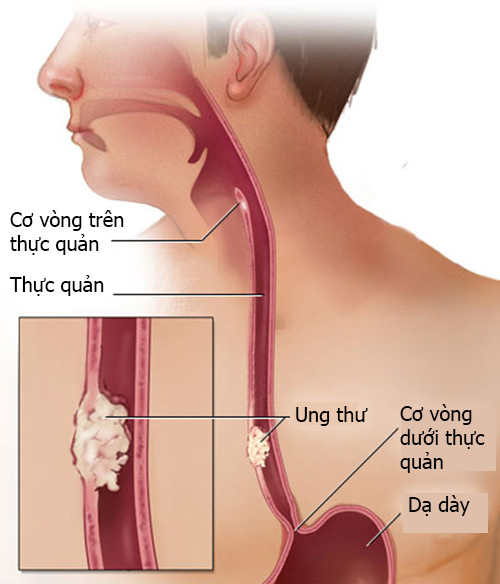 Chẩn đoán ung thư thực quản có thể dựa vào triệu chứng của bệnh kết hợp với chụp Xquang thực quản và các xét nghiệm khác. Nội soi kết hợp với sinh thiết, siêu âm là một biện pháp tốt để chẩn đoán sớm và chính xác bệnh này.
