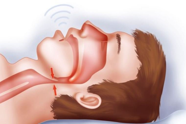 Chứng ngưng thở khi ngủ là hiện tượng một người đột nhiên ngừng thở trong giấc mơ, kết quả là họ tỉnh giấc. Trong khi ngủ, các cơ hầu họng thư giãn, đôi khi dẫn đến tắc nghẽn đường thở. Béo phì, hút thuốc và tuổi già làm tăng nguy cơ bị chứng ngưng thở khi ngủ.