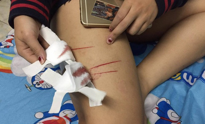 8. Nữ sinh ở TPHCM bị rạch đùi: UBND phường Tân Chánh Hiệp, quận 12, TPHCM xác nhận có vụ nữ sinh bị rạch đùi gây thương tích xảy ra trên địa bàn. Vụ việc đang được công an điều tra, xử lý. Khoảng 10h45 ngày 4/7, sau khi tan học ở trường, nữ sinh X.N. (17 tuổi, ngụ huyện Hóc Môn, TPHCM) hai thanh niên đi xe máy áp sát phía sau và dùng vật nhịn rạch đùi, sau đó tăng ga bỏ chạy. Vết thương dài khoảng 10cm trên đùi trái.