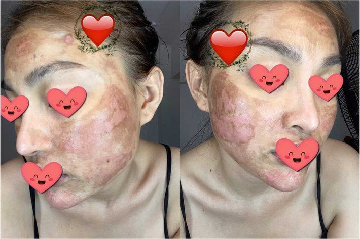 Trong bài chia sẻ của cô gái lạ mặt này, cô được cho là sử dụng sản phẩm peel da của hot girl Trang Nemo vì tin vào lời quảng cáo. au khi dùng, cô nàng phát hiện da mặt mình “bất ổn”, các lớp da bong tróc, thậm chí là đỏ rát.