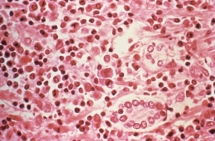 Tiếp đến là Hanta virus - một loại virus mà quân đội Mỹ phải đối mặt khi đóng quân ở Hàn Quốc khiến binh lính bị xuất huyết trong, có thể dẫn đến tử vong nếu không được điều trị kịp thời. Nguồn ảnh: Pinterest.