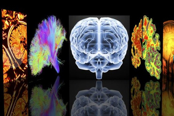 Bệnh đầu tiên có liên quan tới sa sút trí tuệ là bệnh Alzheimer. Bệnh này có biểu hiện là mất trí nhớ ngắn hạn, phán đoán kém và khó khăn trong việc tìm chọn từ đúng.