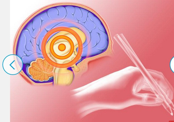 Bệnh Parkinson có biểu hiện là sự thay đổi của cơ thể và trí tuệ (di chuyển chậm chạp, yếu, mất trí nhớ, khó tập trung và gặp khó khăn trong điều hành các chi.