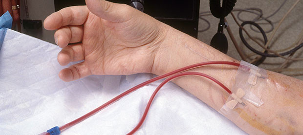 Nephron là đơn vị cấu tạo cũng như đơn vị chức năng của thận, giúp lọc máu. Khi lượng đường trong máu cao, những đơn vị này sẽ trở nên dày hơn và có nhiều sẹo. Nếu không điều trị, bệnh nhân tiểu đường có thể sẽ bị hỏng thận hoàn toàn, buộc họ phải thay thận hoặc lọc máu.