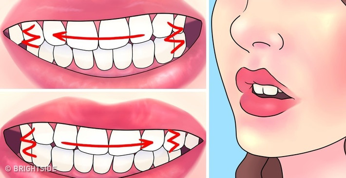 Theo thống kê, có khoảng 8%-31% dân số trên thế giới mắc tật nghiến răng. Nguyên nhân gây nghiến răng có thể do di truyền, yếu tố tâm lý, lệch hàm trên-hàm dưới hay tác dụng phụ của thuốc. Hay nghiến răng nên hàm răng của bạn sẽ trở nên yếu đi, cơ hàm có thể bị đau. Do vậy, bạn nên sớm chữa tật xấu này.