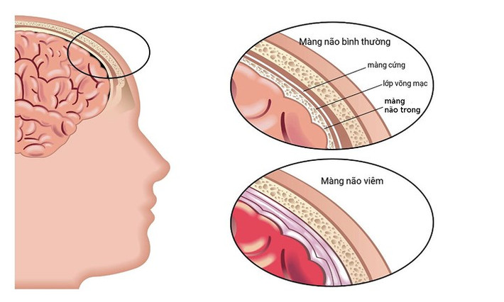 Viêm màng não: Theo MSN, viêm màng não thường do vi khuẩn hoặc virus gây ra, gây nhiễm trùng màng bảo vệ bao quanh não và tủy sống. Bệnh nguy hiểm xuất hiện nhiều ở trẻ sơ sinh, trẻ nhỏ và thanh thiếu niên.