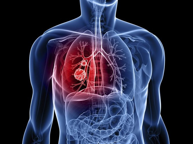 Dịch hạch thể phổi: Các loại bệnh dịch hạch đều do vi khuẩn Yersinia pestis gây ra. Chúng được lây truyền từ bọ chét trên chuột qua người. Nếu không được điều trị, dịch hạch thể phổi có thể giết chết người mắc chỉ trong vòng 18 đến 24 giờ sau khi nhiễm bệnh.