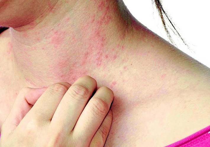 Viêm cân mạc hoại tử: Đây là bệnh nhiễm trùng da cực kỳ nguy hiểm do vi khuẩn gây ra. Nhiễm trùng sẽ nhanh chóng lây lan đến các mô mềm của cơ thể. Tỷ lệ tử vong khi mắc bệnh là khoảng 30 đến 40%. Thông thường, các bác sĩ phải cắt bỏ các cơ quan bị nhiễm trùng để ngăn ngừa vi khuẩn lây lan.