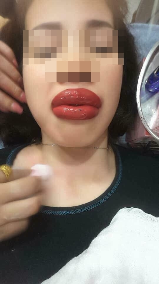 Đôi môi của cô gái này sau khi xăm xong cũng không khá hơn là bao. Ảnh: Tổng hợp