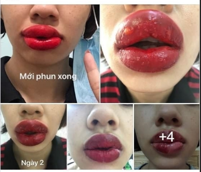 Đây thực sự là một sản phẩm lỗi của công nghệ phun xăm thời hiện đại. Ngay khi những tấm hình chụp cận cảnh đôi môi sưng mọng vẫn còn nguyên mực phun được tung lên mạng xã hội đã gây chú ý đặc biệt.