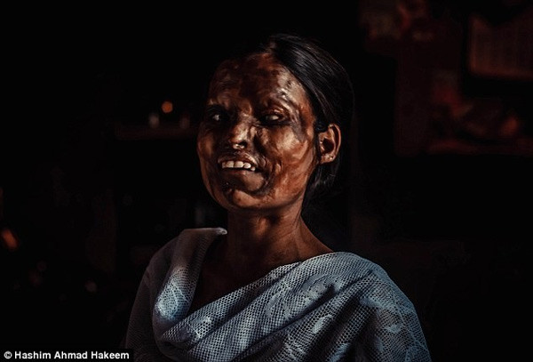 Neetu, sống tại Agra, bang Uttar Pradesh, là cô gái bị tạt axit vào mặt bởi chính cha ruột mình khi cô mới chỉ 3 tuổi. Hành động tàn nhẫn của người đàn ông trong cơn say đã để lại dấu ấn vĩnh viễn trên gương mặt con gái và nỗi đau không thể xóa nhòa. “Những vết sẹo làm tiêu tan mọi mơ ước của tôi”, Neetu, 26 tuổi, nói khi nhắc tới mơ ước trở thành ca sĩ.