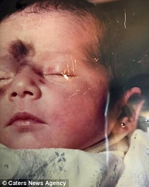 Ngay từ khi mới sinh, cái bớt đã "đồng hành" nhưng màu sắc còn nhạt, nhưng càng ngày nó càng trở nên lớn hơn và đậm màu hơn.
