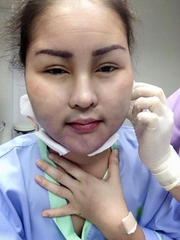 Một cô gái trẻ người Thái Lan có tên Ying Lee Srijumphon đã khiến tất cả phải sững sờ khi quyết định đi hút mỡ khuôn mặt. Kết quả cô nhận được rất tồi tệ. Sau khi hút mỡ, khuôn mặt Ying Lee Srijumphon đã bị biến chứng và gần như biến dạng với rất nhiều vết sưng tấy, bầm tím.