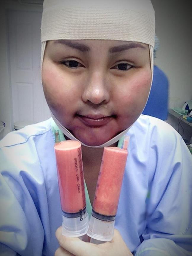 Dù là một cô gái khá ưa nhìn và năng động nhưng Ying Lee Srijumphon vẫn luôn tự ti về khuôn mặt bầu bĩnh của mình. Cuối cùng cô đã quyết định "nhờ vả" đến công nghệ thẩm mỹ để khắc phục. Nhưng cô không thể ngờ rằng điều đó đã khiến khuôn mặt mình biến dạng sau 3 ngày hút mỡ, nhưng vết thâm tím, sưng tấy đã nổi lên khắp cổ và mặt. Cô gái đã rất hối hận về hành động dại dột của mình, giờ đây đối mặt với những hậu quả của việc ''dao kéo'' trên khuôn mặt, Ying Lee Srijumphon rất tuyệt vọng.