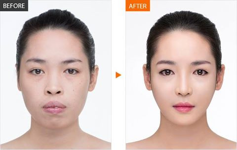 Trong khoảng thời gian công tác định kỳ ở Hàn Quốc sau thẩm mỹ, Thanh Quỳnh thực hiện thêm một ca niềng răng để khắc phục hoàn toàn tật hàm hô. Người đẹp tiết lộ, toàn bộ chi phí cô được đài thọ, ước tính tổng số tiền lên tới 1,5 tỷ đồng. Trong đó, tính riêng chi phí phẫu thuật hàm đã tốn tới 700 triệu đồng, niềng răng là 10.000 USD (hơn 220 triệu đồng) chưa kể chi phí cho các tiểu phẫu khác và làm đẹp da.
