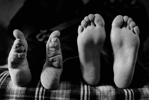 Tập tục bó chân đã làm biến dạng hình dáng và hình ảnh của đôi chân, làm cho chúng trở nên không đẹp mắt và thậm chí xấu xí.